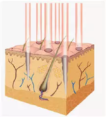 Fractional Lasertechnik Aesthmedic